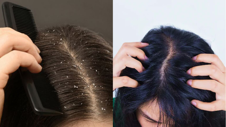 Dandruff vs Dry scalp What’s The Difference
