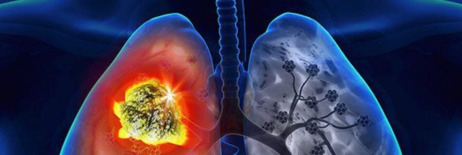 Lung Cancer - Symptoms, Causes, Prevention, And Treatments
