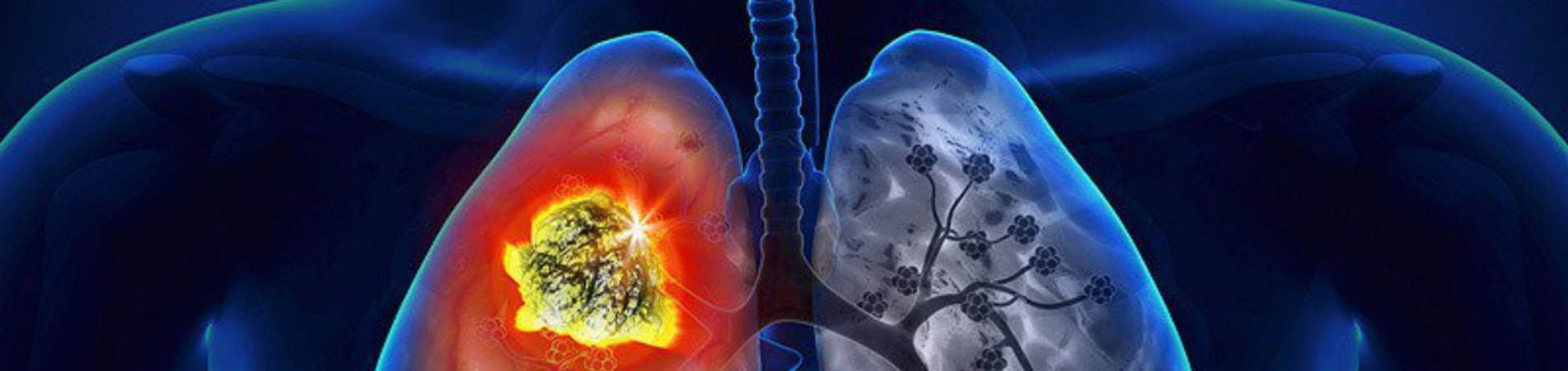 Lung Cancer - Symptoms, Causes, Prevention, And Treatments