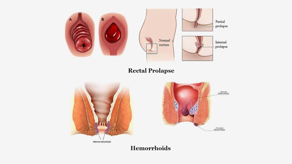 Hemorrhoids Vs Rectal Prolapse: Knowing The Difference  