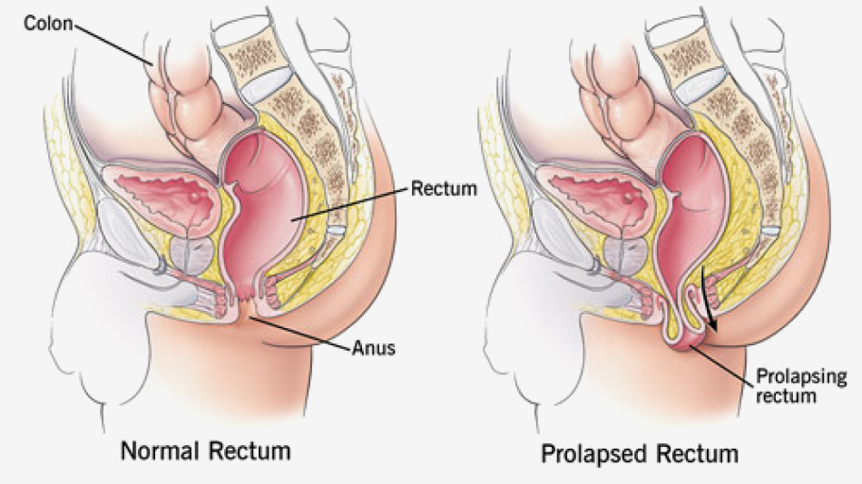 What Is Rectal Prolapse?  